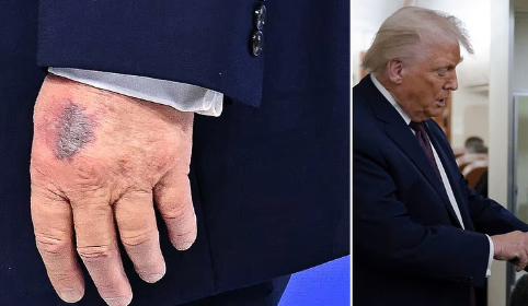 President  Trump sparks health concern as huge bruise is spotted on his hand as he delivers speech in Davos